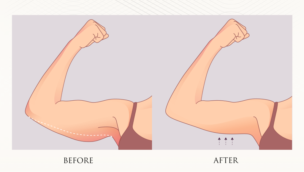Arm Lift Diagram
