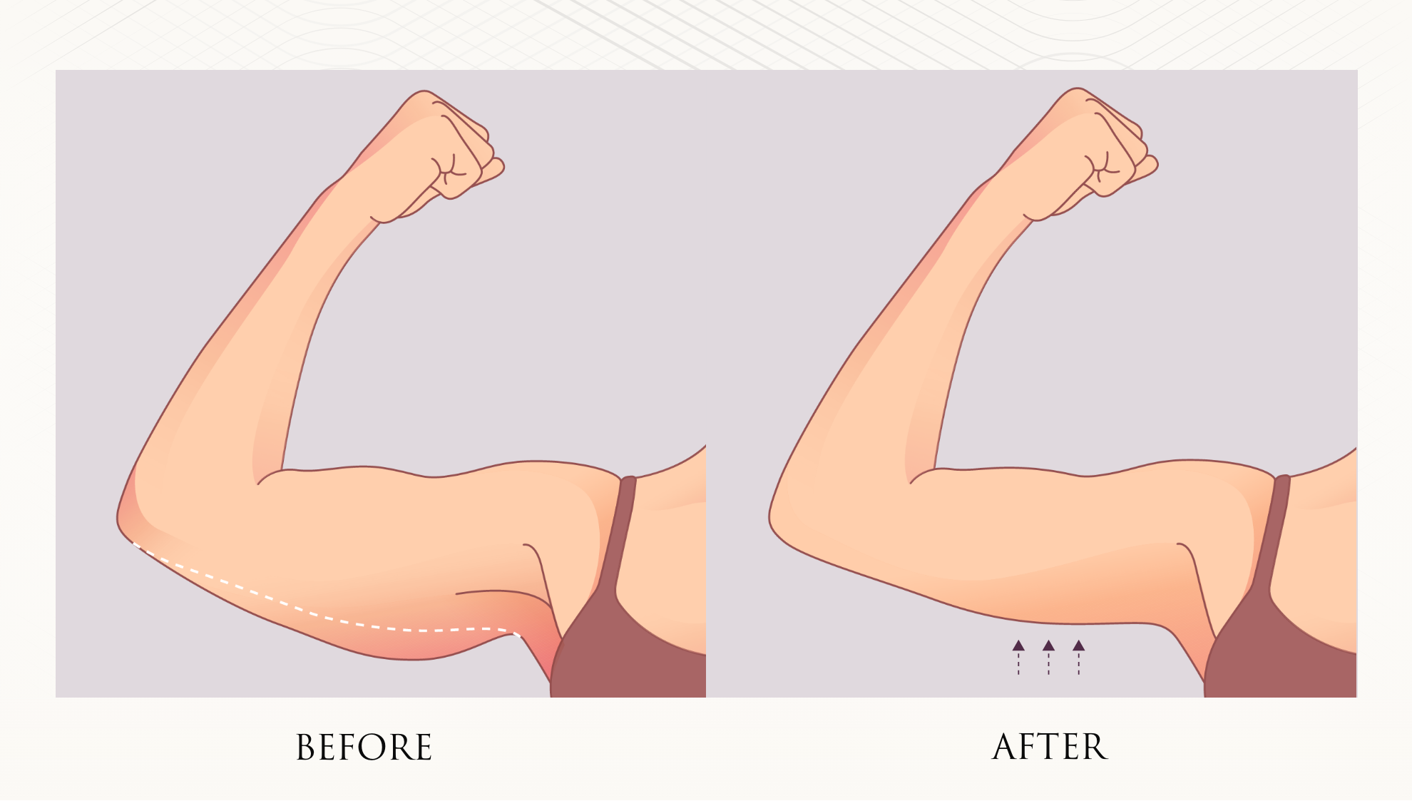 Arm Lift Specialist in Atlanta, GA – Hagopian Plastic Surgery