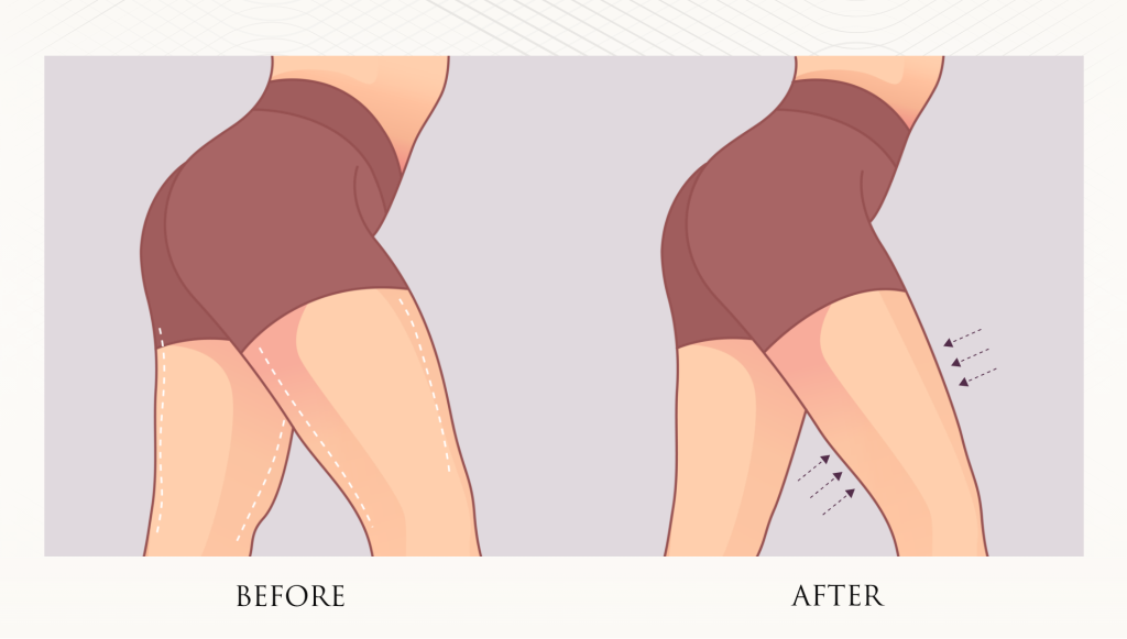Thigh Lift Diagram
