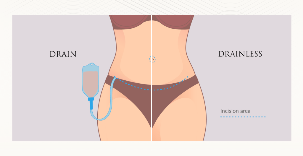 Drainless Tummy Tuck diagram