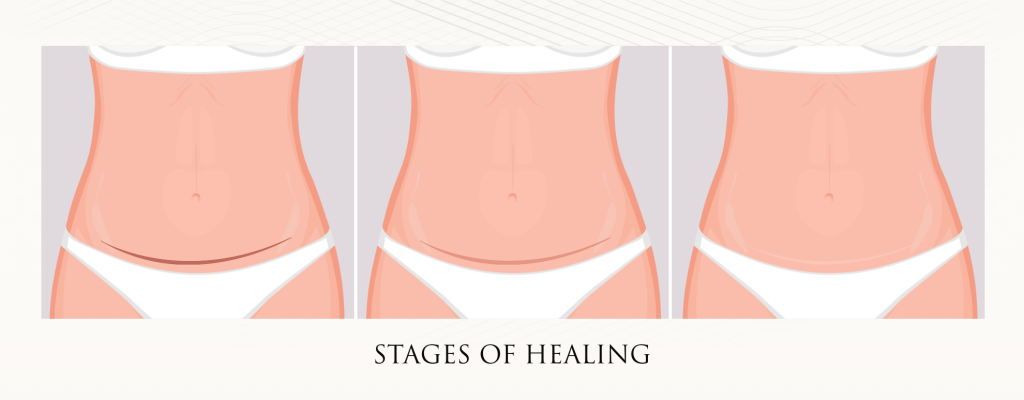 Drainless Tummy Tuck scars diagram