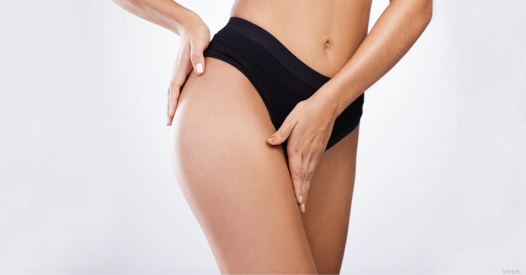 Woman after a thigh lift. (Model)
