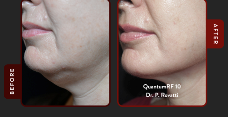 Before and after QuantumRF skin tightening treatment showing improved jawline definition and reduced skin laxity in the lower face.
