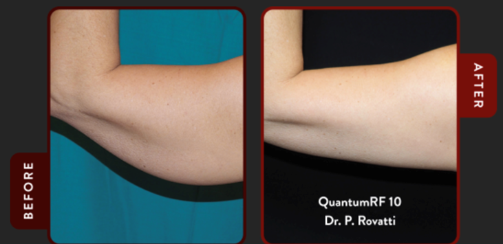 Before and after QuantumRF skin tightening of the upper arm, demonstrating improved skin firmness and smoother contour.