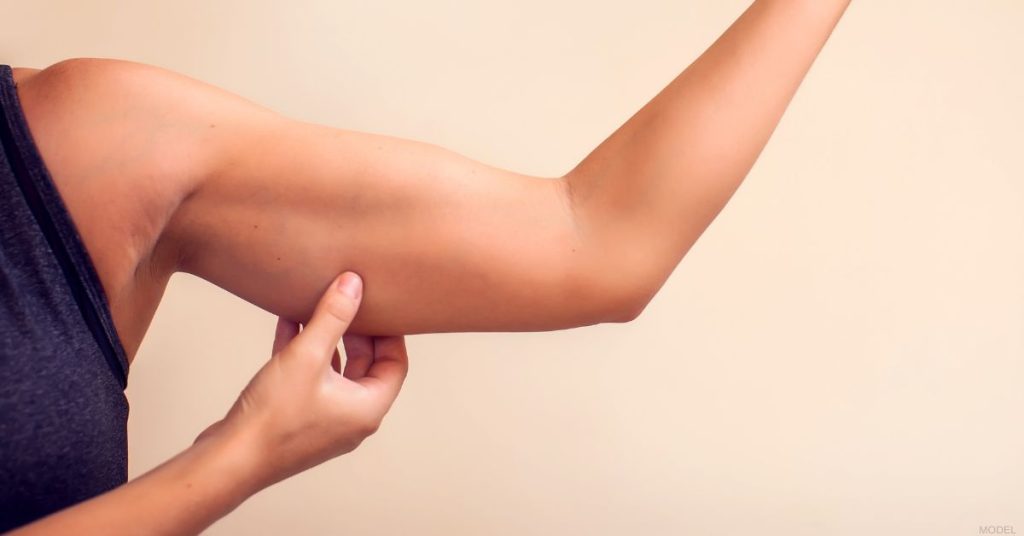 Close-up of a person's upper arm showing loose skin, illustrating concerns that may lead someone to consider an arm lift or arm liposuction. (Model)
