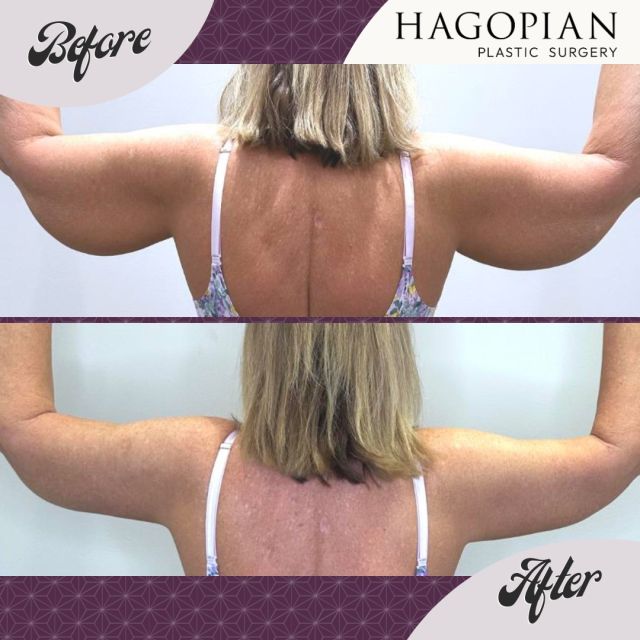 #brachioplasy 6 weeks Post-Op! Even with summer coming to a close, our patient has newfound confidence in short sleeve shirts thanks to this arm lift. Using 360 lipo on the forearms and upper arms, we achieved a more toned, slim appearance to her arms. This patient has been using Silagen, sold at our office, for a few weeks on her incisions and is already seeing flatter, minimized scars. Call for a consultation today!

#brachioplasty #armlift #liposuction #360lipo #lipo #plasticsurgery #cosmeticsurgery #slimmerarms #atlantaplasticsurgery #plastics