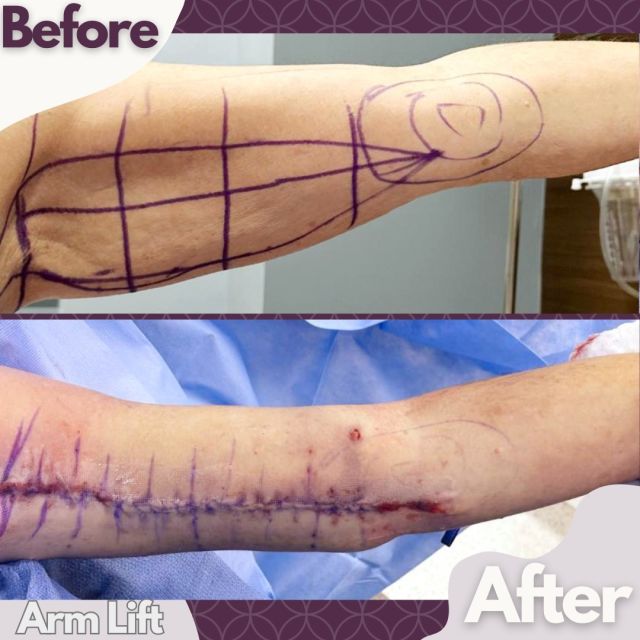 Brachioplasty on table result. This is one of two #Brachioplasty surgeries that I performed today. These are also Known as an #armlift, it is a excellent procedure for people who have a little bit of extra skin and fat on the upper arms. This patient also happens to have #Lipedema, but it’s virtually the same for my cosmetic patients. Most people have some extra fat on the upper arm as well as extra skin and so I start with 360 #liposuction of the upper arm. Occasionally people also have fat on their forearms, and I would liposuction that as well. Once the fat is removed, we can then address the skin. We staple the skin together to check to make sure it’s tight enough, but not too tight and then the staples and extra skin are removed, and stitched closed. Your clothes will fit better and you can be more confident in your arms. As long as you take good care of the scars using a silicone scar product such as #silagen the scar is manageable and well hidden on the inside of the arm. I’ll do my best to post the other photo tomorrow.

#drthomashagopian #hagopianplasticsurgery #atlanta #atlantaplasticsurgeon #plasticsurgery #cosmeticsurgery #cosmeticprocedures #cosmeticprocedure #atlantacosmeticsurgery #beforeandafter
