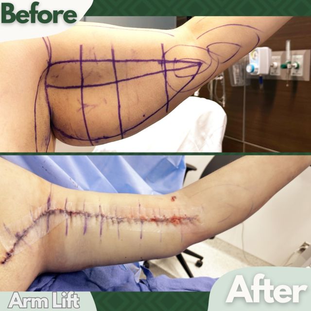 Another arm lift on table. This is the second case. I did yesterday of a #Bracioplasty also known as an arm lift. Patient also has Lipedema and has been seeing me for her lipedema reduction surgeries for a number of months. Today she was ready to have her arms treated. We performed 360 liposuction of the upper arms shoulders and forearms for lipedema, followed by skin removal in a brachioplasty style to the upper arm. For someone like this patient liposuction is really important. We took over a liter of fat from her upper arm to really give her a smaller arm circumference. When you don’t do 360 Lipo, you can’t get these arms to the smaller size. She’s doing well today and she should have a great recovery.

#drthomashagopian #hagopianplasticsurgery #atlanta #atlantaplasticsurgeon #plasticsurgery #cosmeticsurgery #cosmeticprocedures #cosmeticprocedure #atlantacosmeticsurgery #beforeandafter #liposuction #Bracioplasty #Lipedema