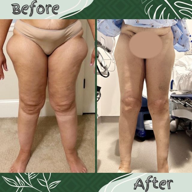 There are a lot of ways to do a thigh lift. For some people with a small amount of extra skin on the inside of their thighs, you can hide the entire scar in the groin. for a lot of patients with extra skin all over the leg, there’s no way to hide the incisions. With good scar management, the incisions will fade and the results can be pretty dramatic. This patient had a couple stages of debulking liposuction, followed by an extended spiral thigh, hip, knee and calf lift. She needed all of these areas of skin removed because she had extra skin in all these areas. her results are pictured here. This surgery was carried out in two stages. This was for the treatment of lipidemia, but massive weight loss patients frequently need these incisions as well.

The extended spiral thigh lift starts on the back, and includes a lateral hip lift, which raises up the saddlebags on the side and treats the outside of the leg, then moves into the groin on the front and treats the front of the leg, and then eventually down the thigh to treat the rest of the leg. When you have a lot of extra skin above your knee, the knee lift is what you wanna do. This gives you a sharp knee and is honestly the best way to treat this area, which is a notoriously difficult area to treat. The scar above the knee fades well overtime.

#drthomashagopian #hagopianplasticsurgery #atlanta #atlantaplasticsurgeon #plasticsurgery #cosmeticsurgery #cosmeticprocedures #cosmeticprocedure #atlantacosmeticsurgery #beforeandafter #lipedema #liposuction #thighlift #thighplasty #looseskin #looseskinremoval #skinremovalsurgery #skinremoval #skinremovalafterwls #thighliftsurgery #kneelift #calflift